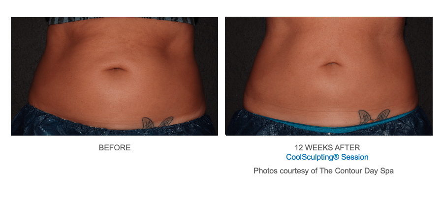 12 Weeks After CoolSculpting Session The Contour Day Spa