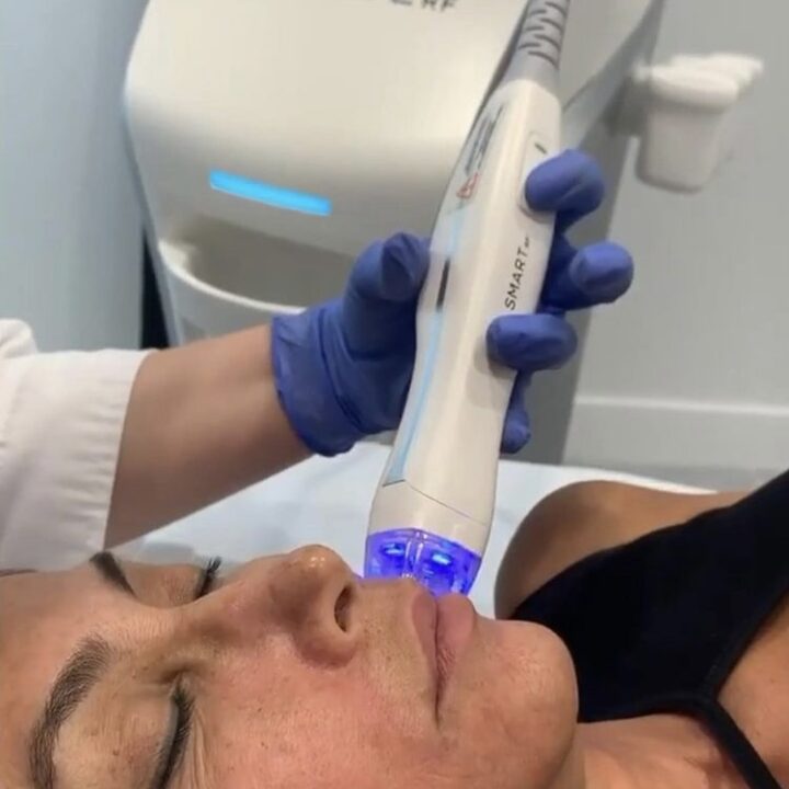 Care for Your Skin before and after a microneedling treatment