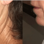 Virtue RF Microneedling Before and After Images